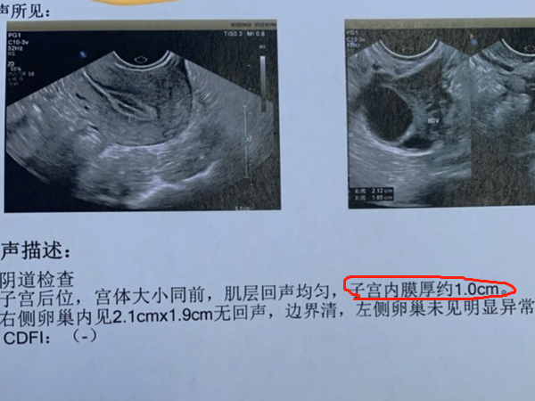 内膜2.6mm对怀孕的影响一定要看，除了导致不来月经还有它