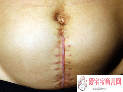广州助孕哪个医院比较好_疤痕体质的孕妇剖腹产是怎样的体验疤痕体质有多可