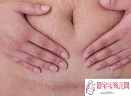 广州助孕哪个医院比较好_疤痕体质的孕妇剖腹产是怎样的体验疤痕体质有多可